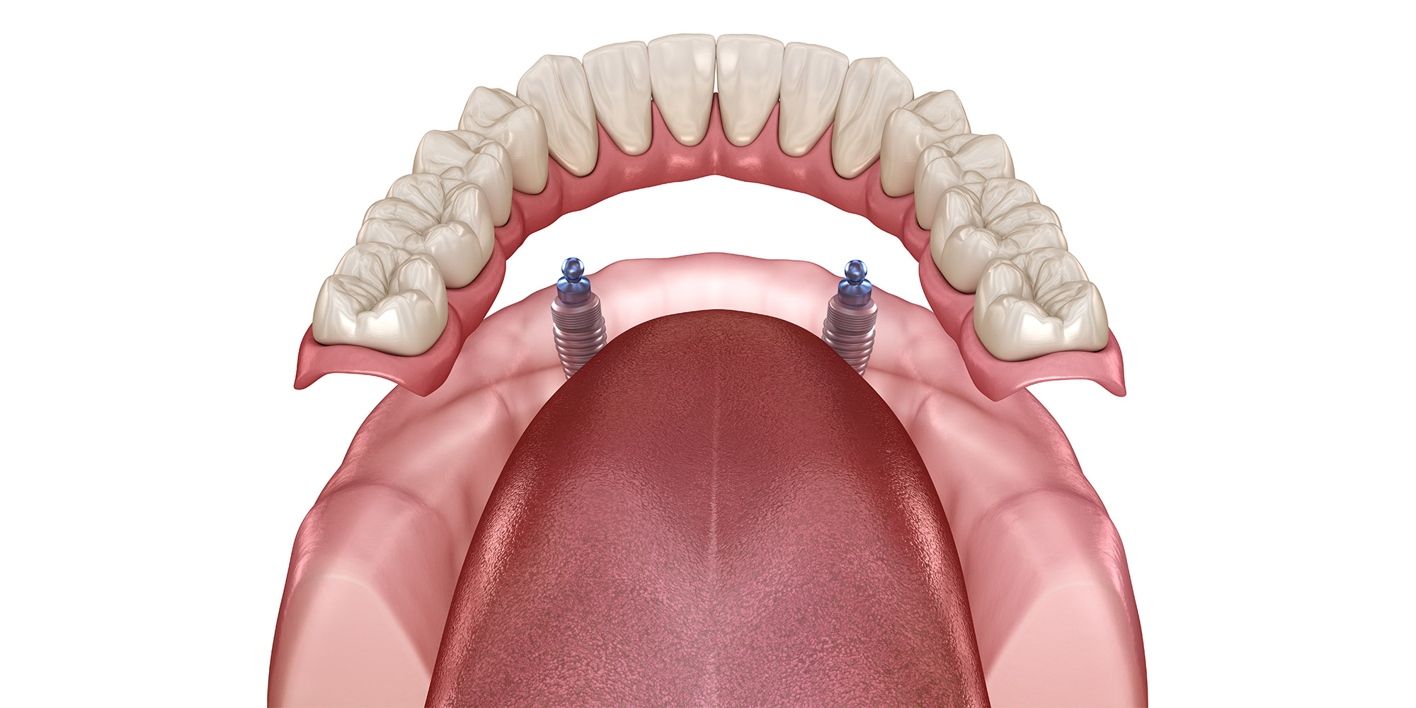 Implant supported dentures example model