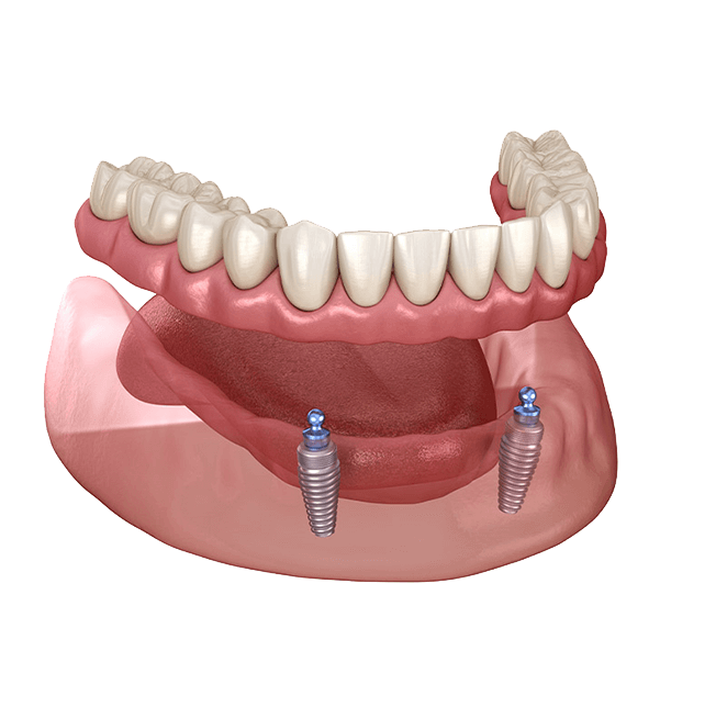 Implant supported denture