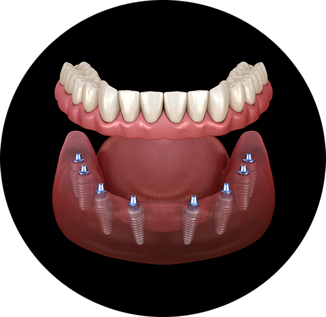 Implant supported denture